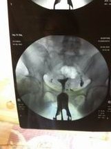 移植失败的原因通常有哪些？