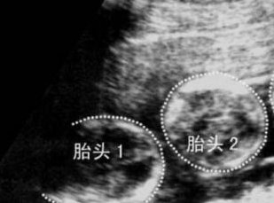 做试管婴儿需要离职吗？试管婴儿哪些时间需要待在医院？